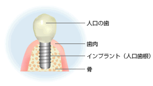 インプラント治療