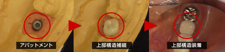 (STEP8)上部構造印象採得(型採り)