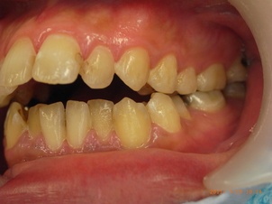 上顎前突と開口と下顎前歯部叢生による矯正治療