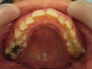 上顎前突と開口と下顎前歯部叢生による矯正治療