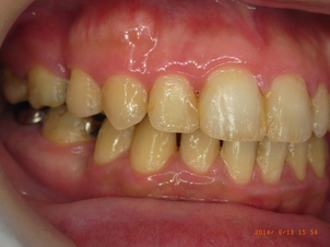 上顎前突と開口と下顎前歯部叢生による矯正治療