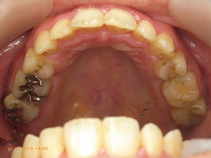 上顎前突と開口と下顎前歯部叢生による矯正治療
