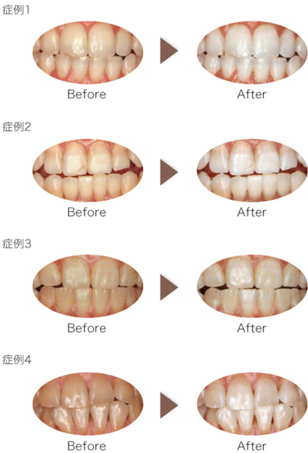 当院で行ったホワイトニング症例